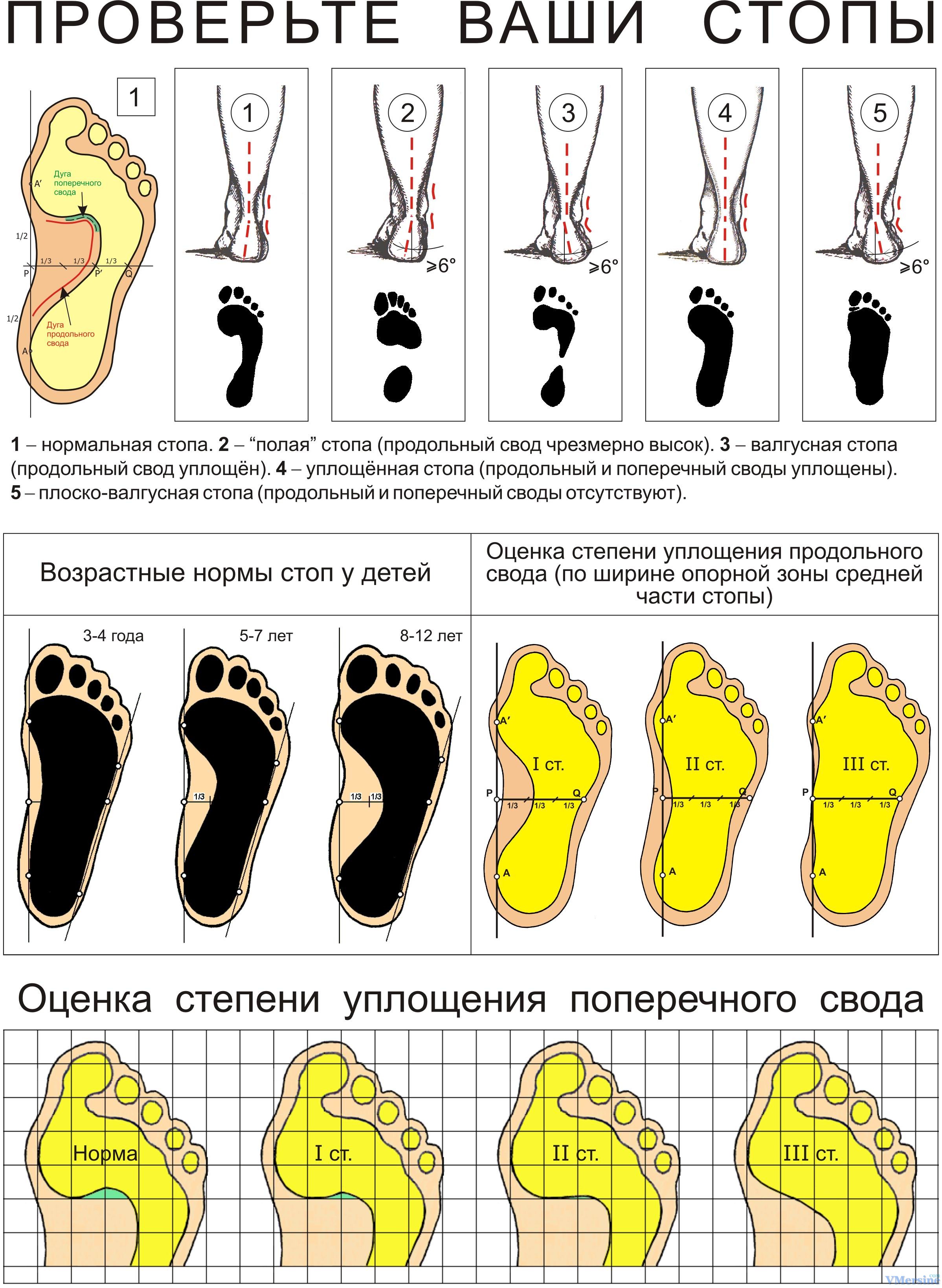 Поперечное плоскостопие отпечаток стопы