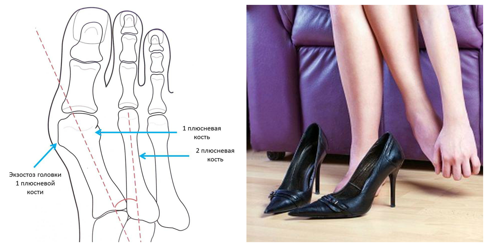 Почему появляется косточка на большом пальце ноги, и как ее удалить? |  VMersine.com